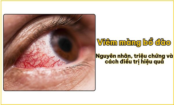 Viêm màng bồ đào: Nguyên nhân, triệu chứng và cách điều trị