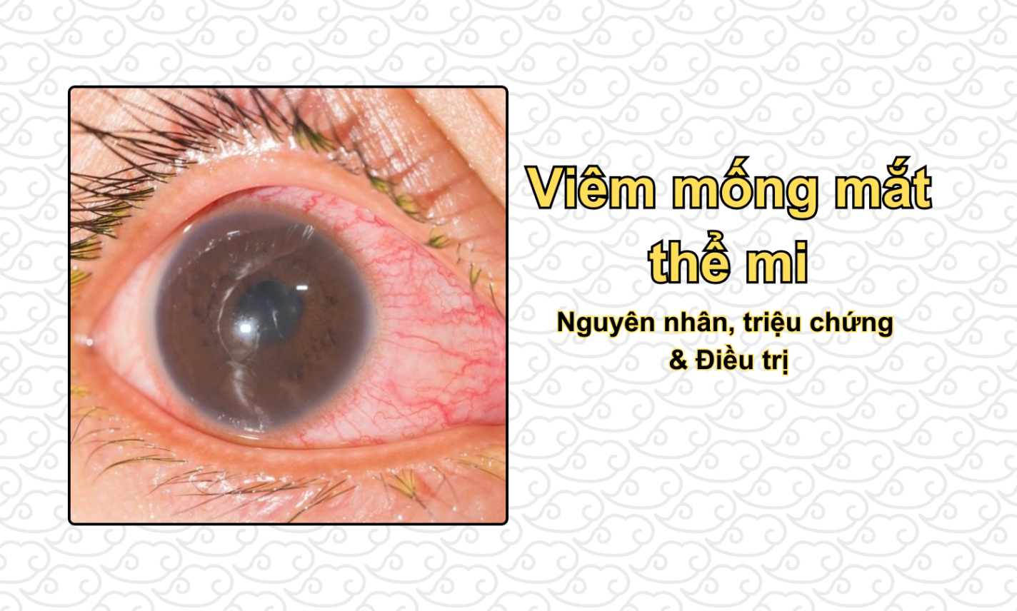 Viêm mống mắt thể mi: Nguyên nhân, triệu chứng & Điều trị