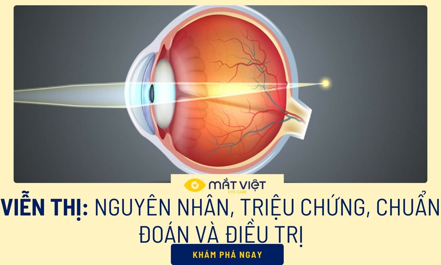 Viễn thị là gì: Nguyên nhân, triệu chứng của viễn thị