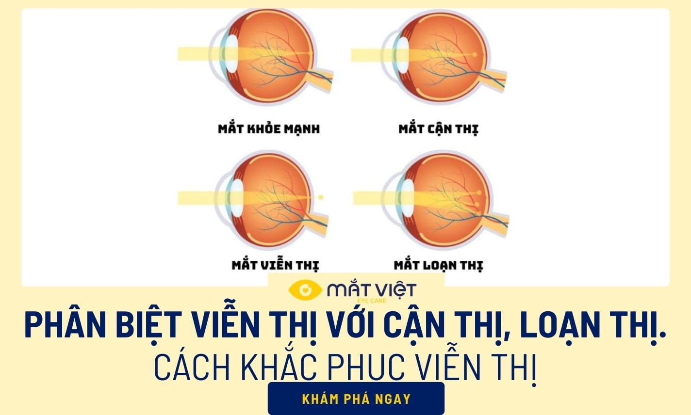 Phân biệt viễn thị với cận thị, loạn thị và cách khắc phục