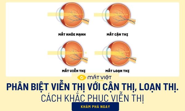 Phân biệt viễn thị với cận thị, loạn thị và cách khắc phục