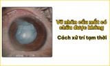 Vỡ nhãn cầu mắt có chữa được không? Cách xử trí tạm thời