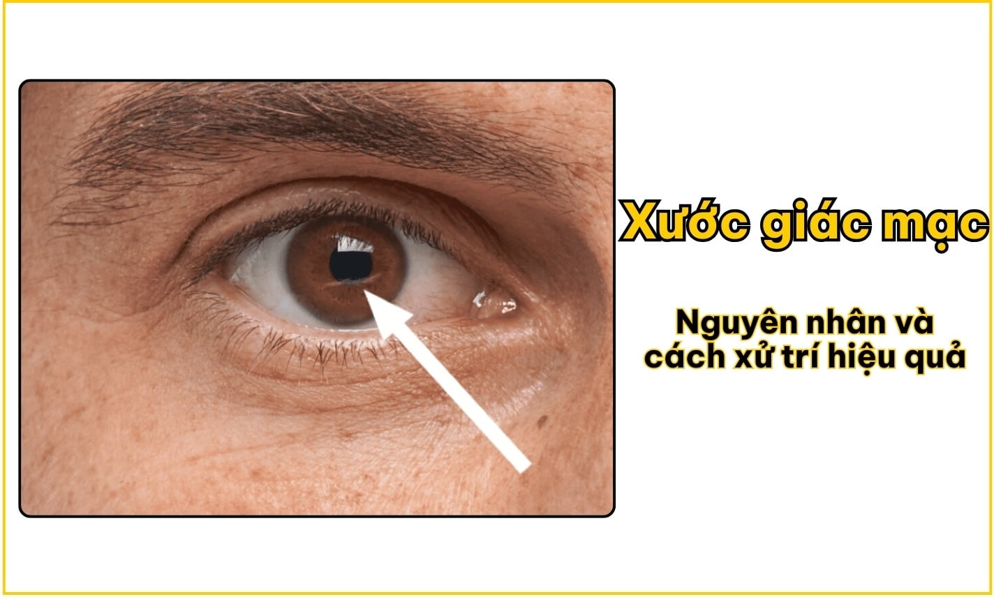 Xước giác mạc: Nguyên nhân và cách xử trí hiệu quả