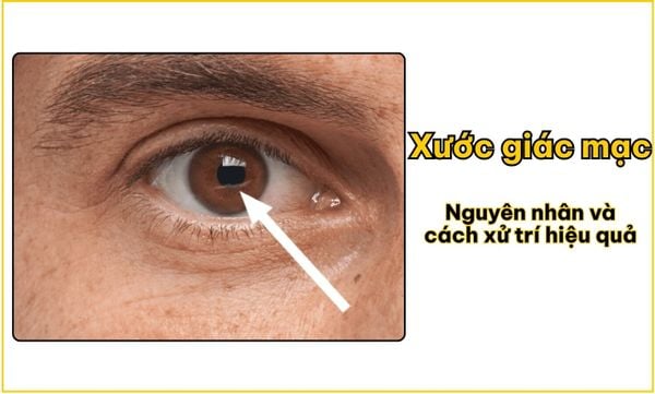 Xước giác mạc: Nguyên nhân và cách xử trí hiệu quả