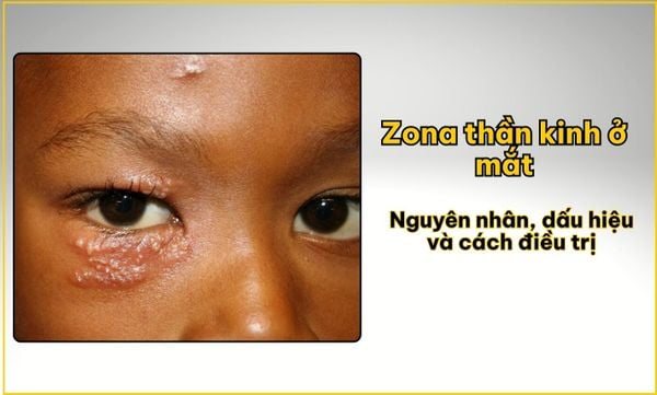 Zona thần kinh ở mắt: Nguyên nhân, dấu hiệu và cách điều trị