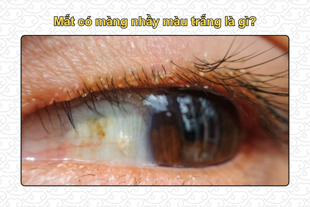 mat-co-mang-nhay-mau-trang-la-gi