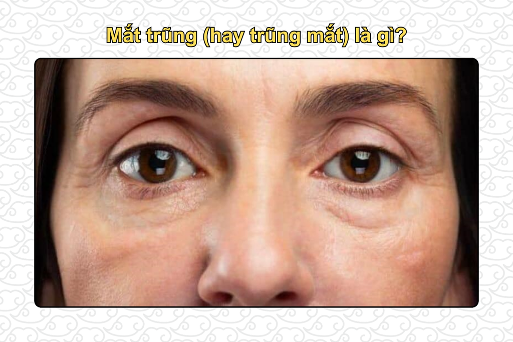 mat-trung-hay-trung-mat-la-gi