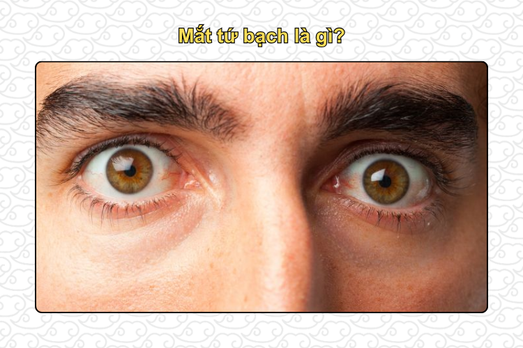 Mắt tứ bạch là gì?
