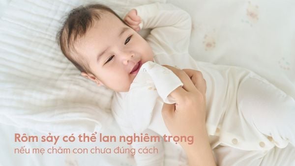 Rôm sảy ở trẻ sơ sinh: 6 dấu hiệu mẹ cần biết và cách xử trí