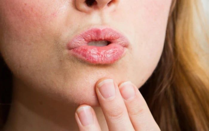 Khô rát viền môi: Nguyên nhân và cách khắc phục hiệu quả