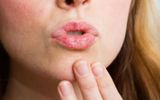 Khô rát viền môi: Nguyên nhân và cách khắc phục hiệu quả