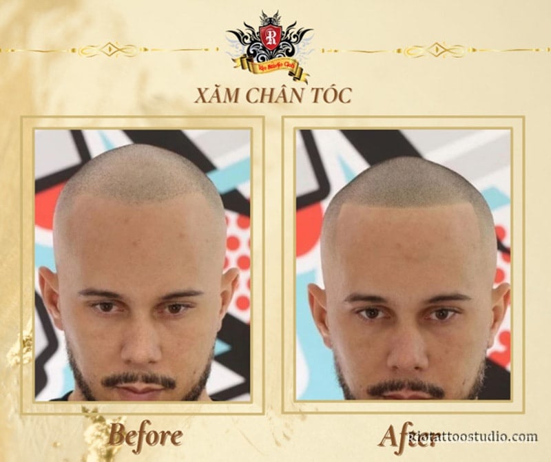 Xăm chân tóc – Giải pháp giúp lấy lại sự tự tin cho người hói