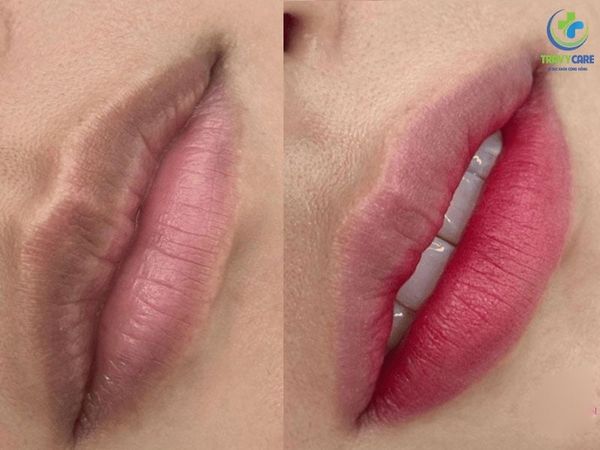 Hình ảnh thực tế trước và sau khi thực hiện khử thâm môi của khách hàng tại Thẩm mỹ Rio, cho thấy sự cải thiện rõ rệt từ nền môi thâm sạm sang hồng hào trong trẻo.