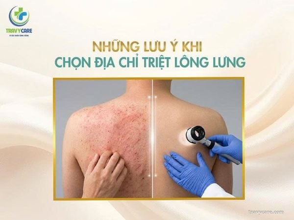 Những lưu ý quan trọng giúp bạn dễ dàng lựa chọn được địa chỉ triệt lông lưng an toàn và chuẩn y khoa hiện nay.
