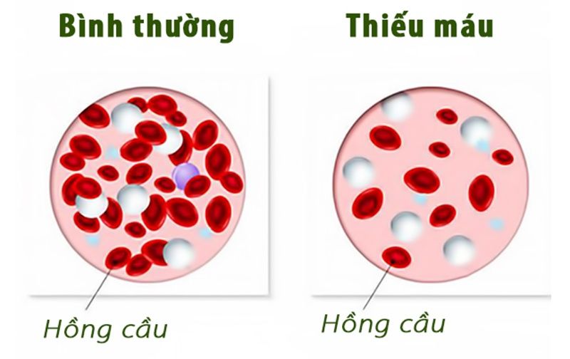 Dấu.hiệu cảnh.báo T.HIẾU M.ÁU mà nhiều người không hề biết