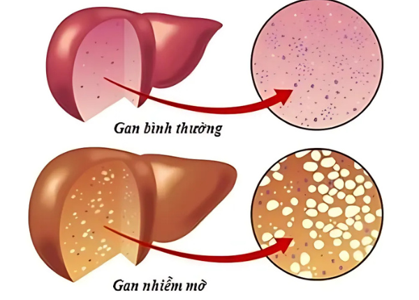 5 bước quan trọng giúp ngăn biến chứng gan nhiễm mỡ không do rượu