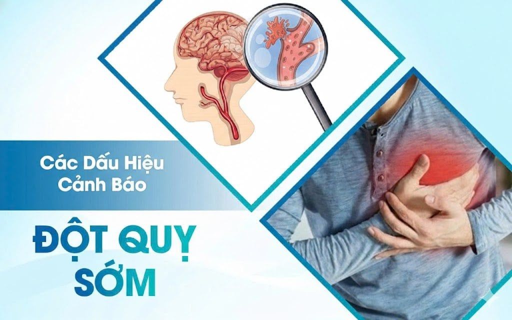 💥 Dấu hiệu cảnh báo đột quỵ sớm – tuyệt đối không nên bỏ qua