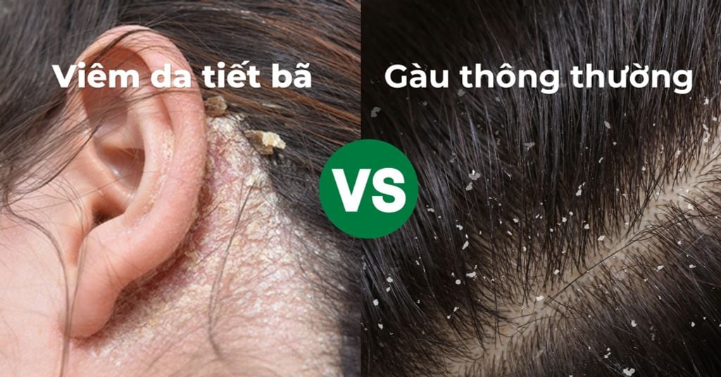 Phân biệt viêm da tiết bã và gàu thông thường để có hướng điều trị chuyên biệt
