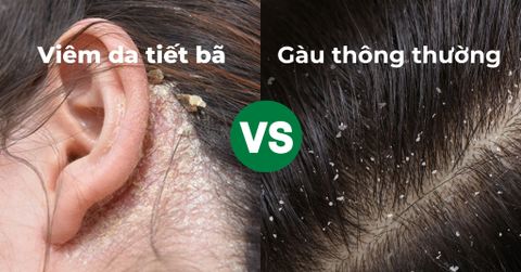 Phân biệt viêm da tiết bã và gàu thông thường để có hướng điều trị chuyên biệt