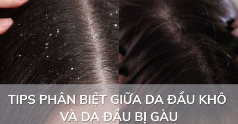 Da đầu khô căng, bong vảy trắng: Khác gì với gàu dầu?
