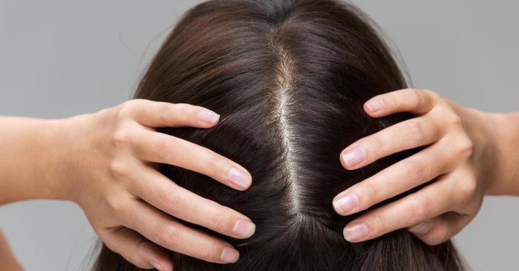 Da đầu nhạy cảm: Dấu hiệu nhận biết và cách chăm sóc đúng