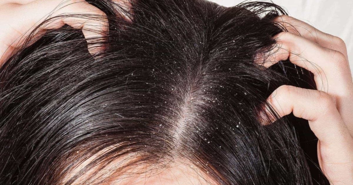 Cảm giác “kiến bò” trên da đầu: Stress hay bệnh lý da liễu?