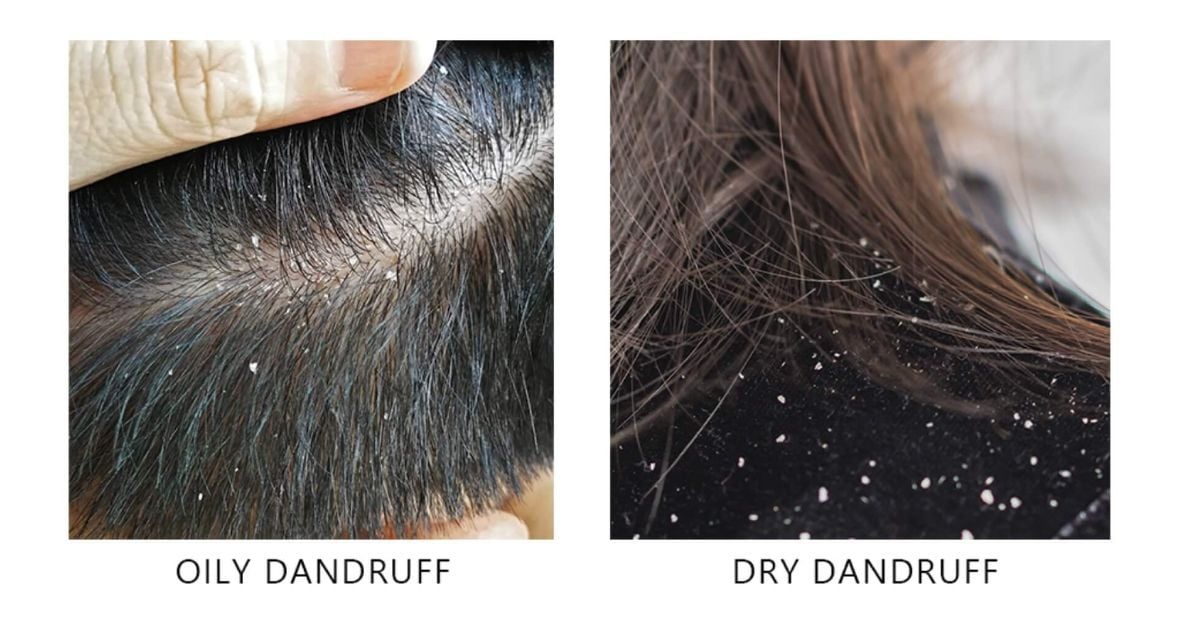 Gàu ướt và gàu khô: Phác đồ điều trị khác nhau như thế nào để tránh tái phát?