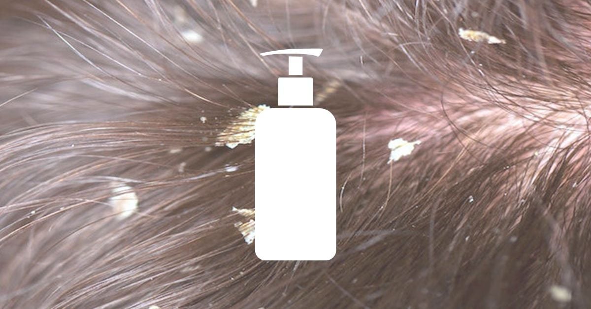 Tại sao dùng dầu gội trị gàu siêu thị lại làm tóc khô như rơm?