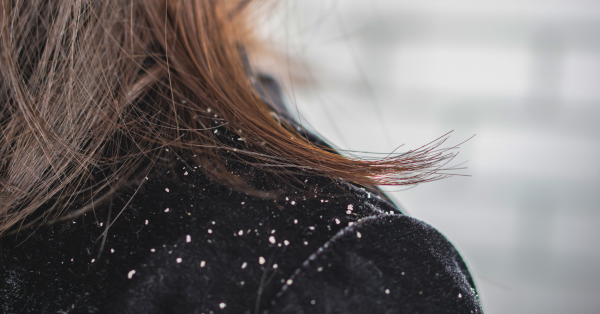 Tại sao mùa đông da đầu hay bị bong tróc vảy trắng? (Góc nhìn y khoa)