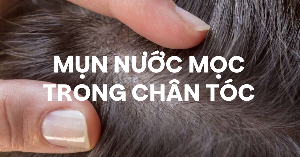 Mụn nước mọc trong chân tóc: Nguyên nhân do bít tắc nang tóc hay dị ứng Silicon?