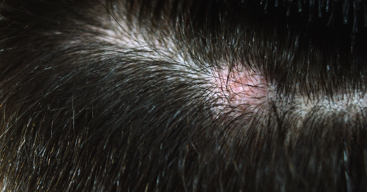 Da đầu nhạy cảm, dễ ửng đỏ khi gội đầu: 3 thành phần trong dầu gội bạn nên tránh xa