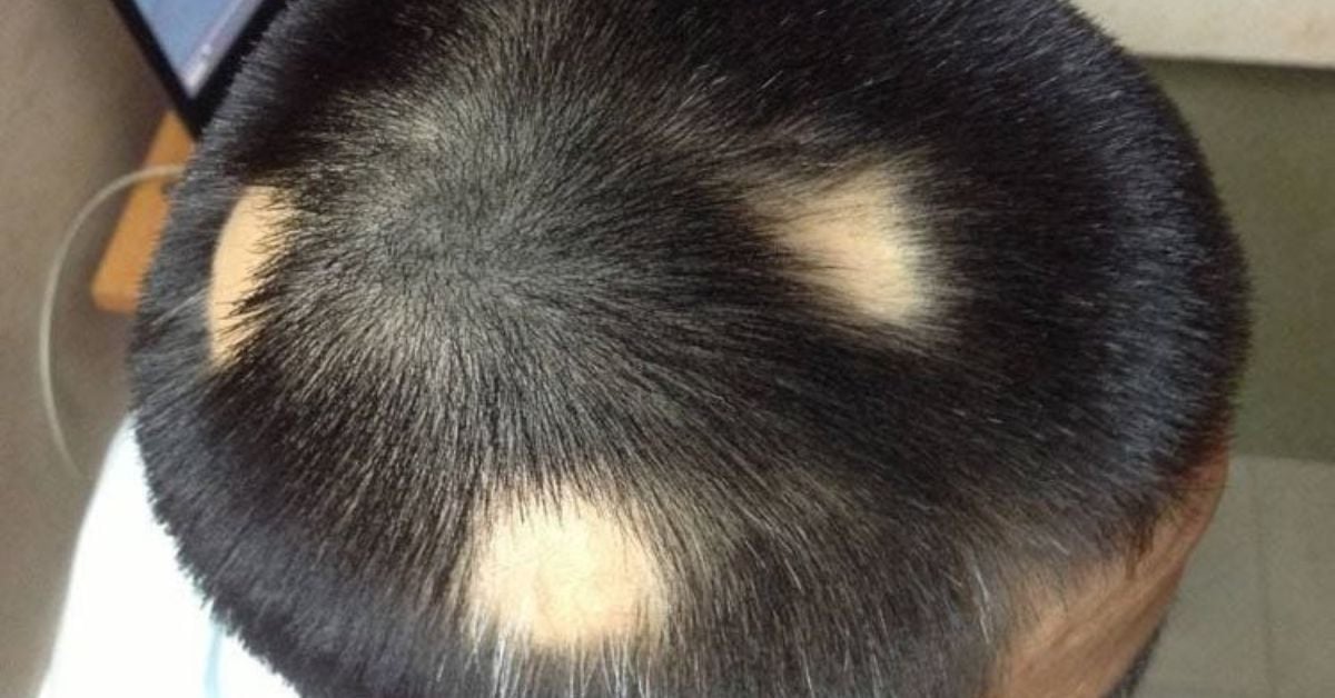 Rụng tóc từng mảng (Alopecia Areata) có tự khỏi không hay cần can thiệp Ginseng?