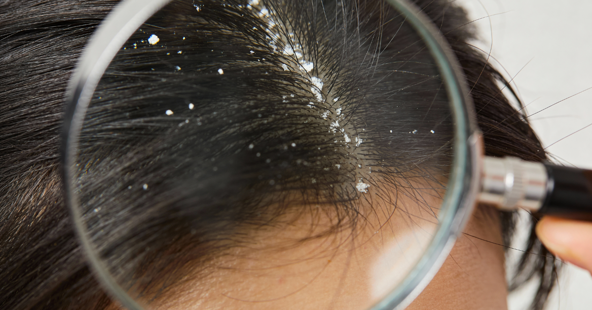 Bệnh nấm tóc (Tinea Capitis) ở trẻ em và người lớn: Dùng dầu gội thảo dược có hết không?