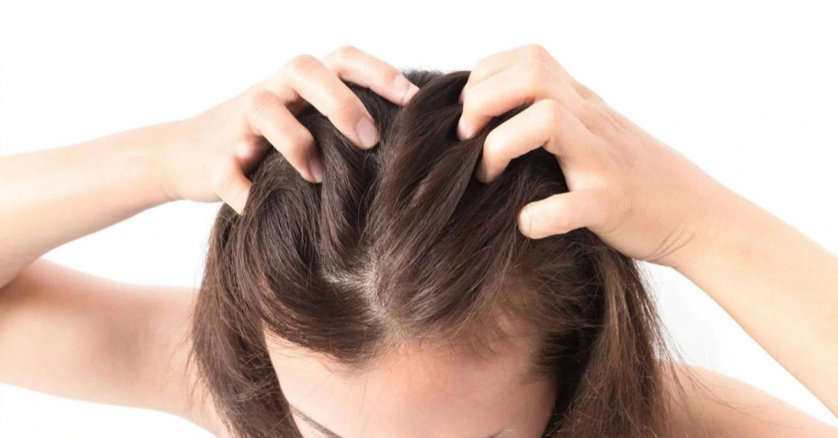 Ngứa da đầu kéo dài: 5 nguyên nhân và cách trị ngứa & cân bằng độ pH da đầu bằng thảo mộc tự nhiên