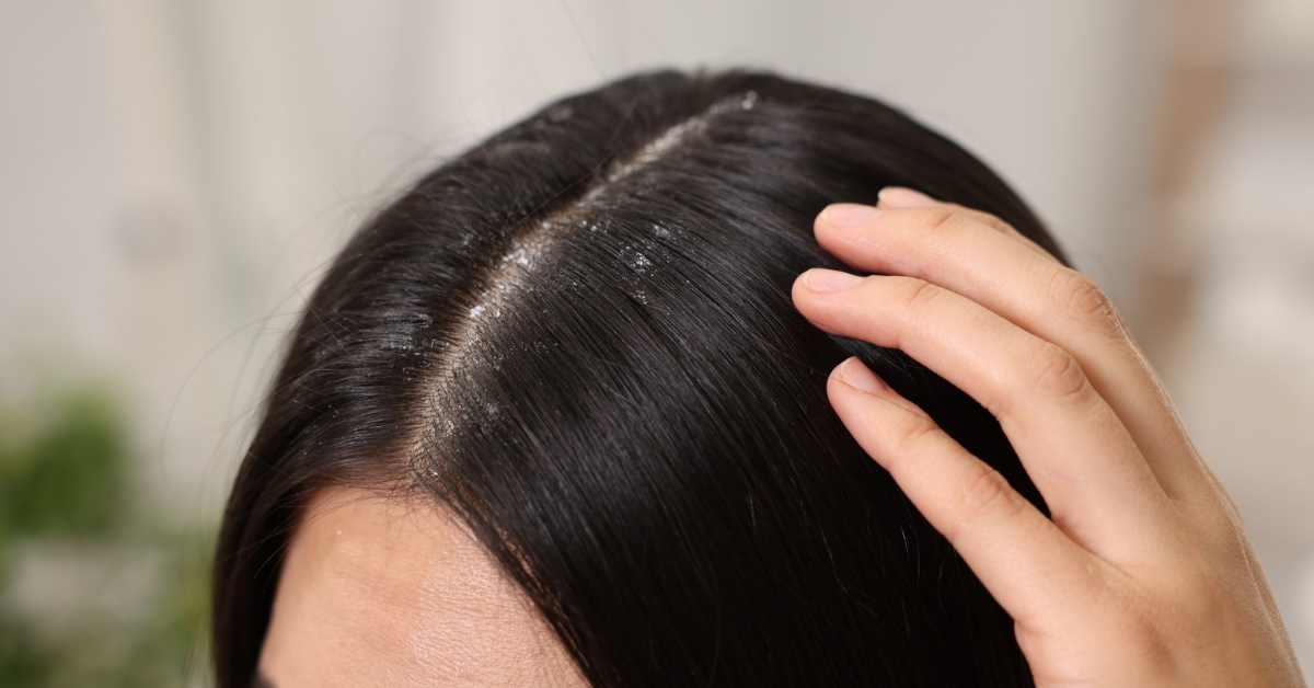 Da đầu Gàu: Nguyên nhân và cách khắc phục hiệu quả