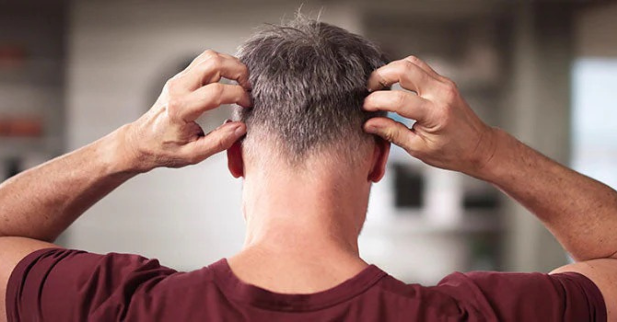 Biện pháp khắc phục rụng tóc cho nam giới: Nguyên nhân, thuốc và cách chăm sóc hiệu quả