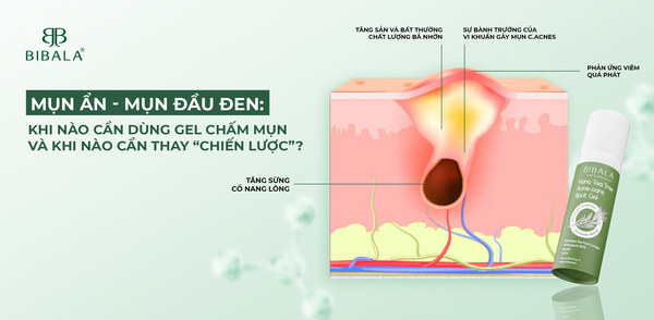 MỤN ẨN - MỤN ĐẦU ĐEN: KHI NÀO CẦN DÙNG GEL CHẤM MỤN VÀ KHI NÀO CẦN THAY “CHIẾN LƯỢC”?