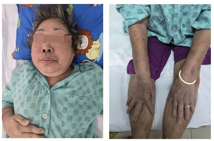 Suy thượng thận mạn do thuốc: Cảnh giác lạm dụng corticoid và thuốc không rõ nguồn gốc