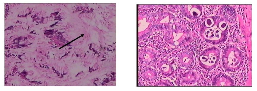Giun lươn: “Thủ phạm thầm lặng” núp bóng ung thư dạ dày