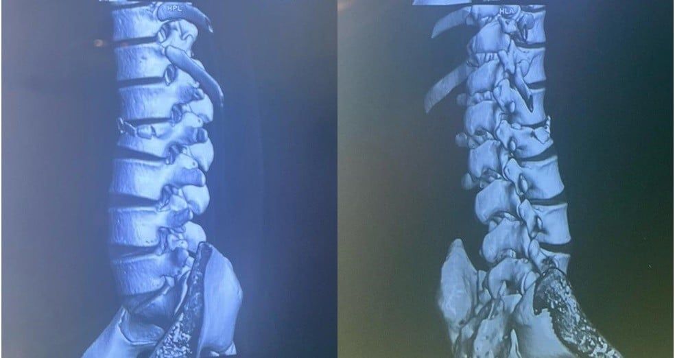 Đừng để một phút chủ quan trong lao động đổi lấy cả đời trên giường bệnh