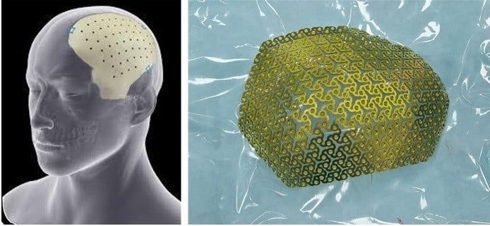 An toàn, thẩm mỹ và bền vững: ưu điểm vượt trội của ghép sọ nhân tạo bằng kỹ thuật 3D tại Bệnh viện Nhân dân 115