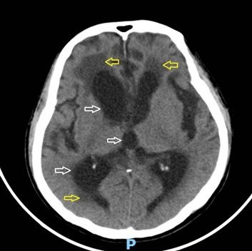 Sa sút trí tuệ ở người cao tuổi, có thật chỉ là câu chuyện “sống chung với lũ”?