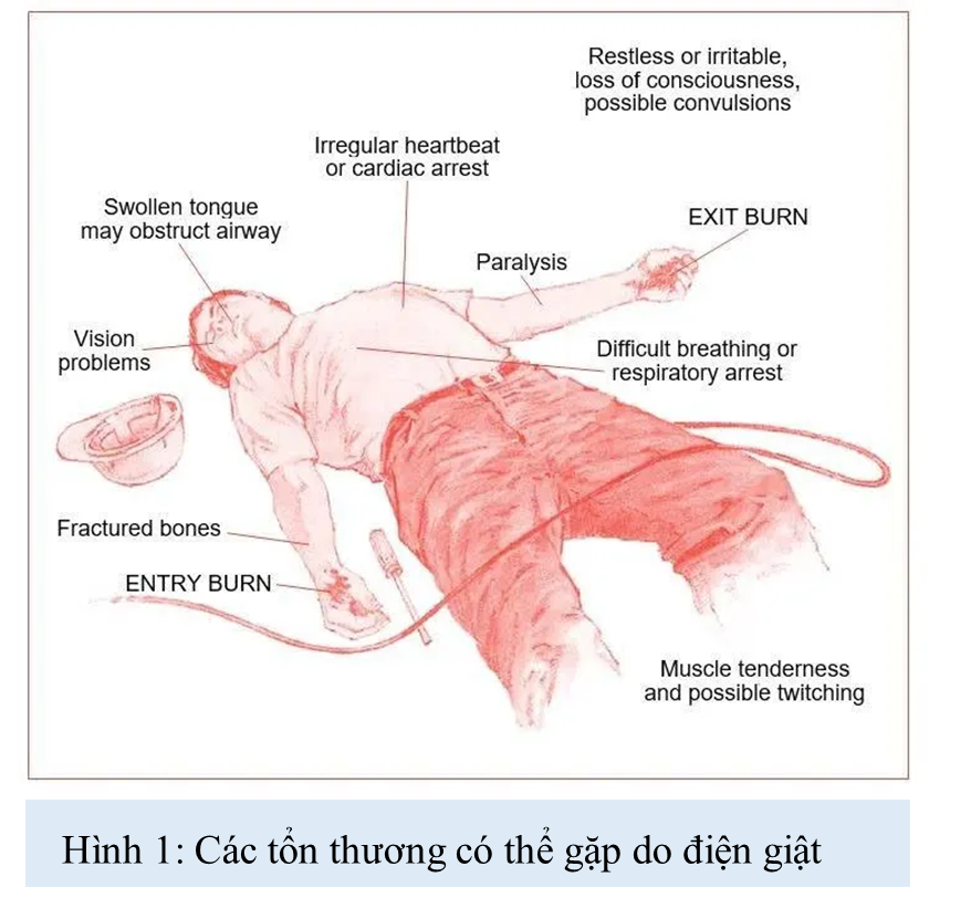 Trước thềm xuân 2026: giành lại nhịp tim cho người bệnh trẻ bị ngừng tim sau điện giật