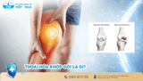 Thoái hóa khớp gối và những biến chứng nguy hiểm nếu không điều trị kịp thời
