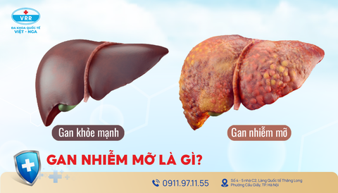 Hiểu đúng về bệnh gan nhiễm mỡ – căn bệnh thầm lặng nhưng nguy hiểm