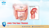 Ung thư đại tràng - những điều cần biết