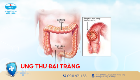 Ung thư đại tràng - những điều cần biết