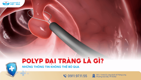 Polyp đại tràng là gì? Những thông tin không thể bỏ qua