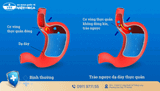 TRÀO NGƯỢC DẠ DÀY: TRIỆU CHỨNG, NGUYÊN NHÂN VÀ CÁCH ĐIỀU TRỊ