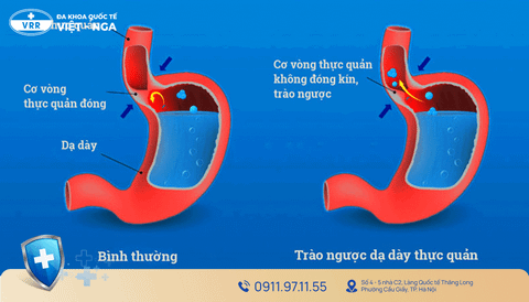 TRÀO NGƯỢC DẠ DÀY: TRIỆU CHỨNG, NGUYÊN NHÂN VÀ CÁCH ĐIỀU TRỊ